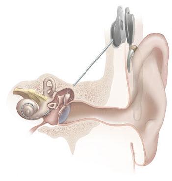 人工耳蜗植入